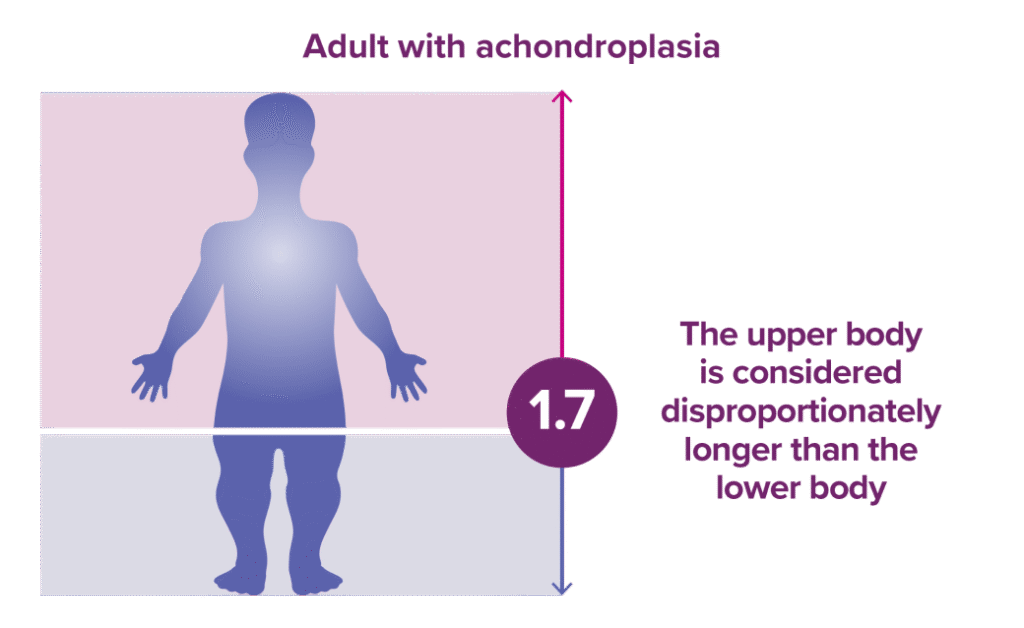 An exmaple of a person with achondroplasia who has a disproportionate upper vs lower body ratio. The ratio is 1.7.