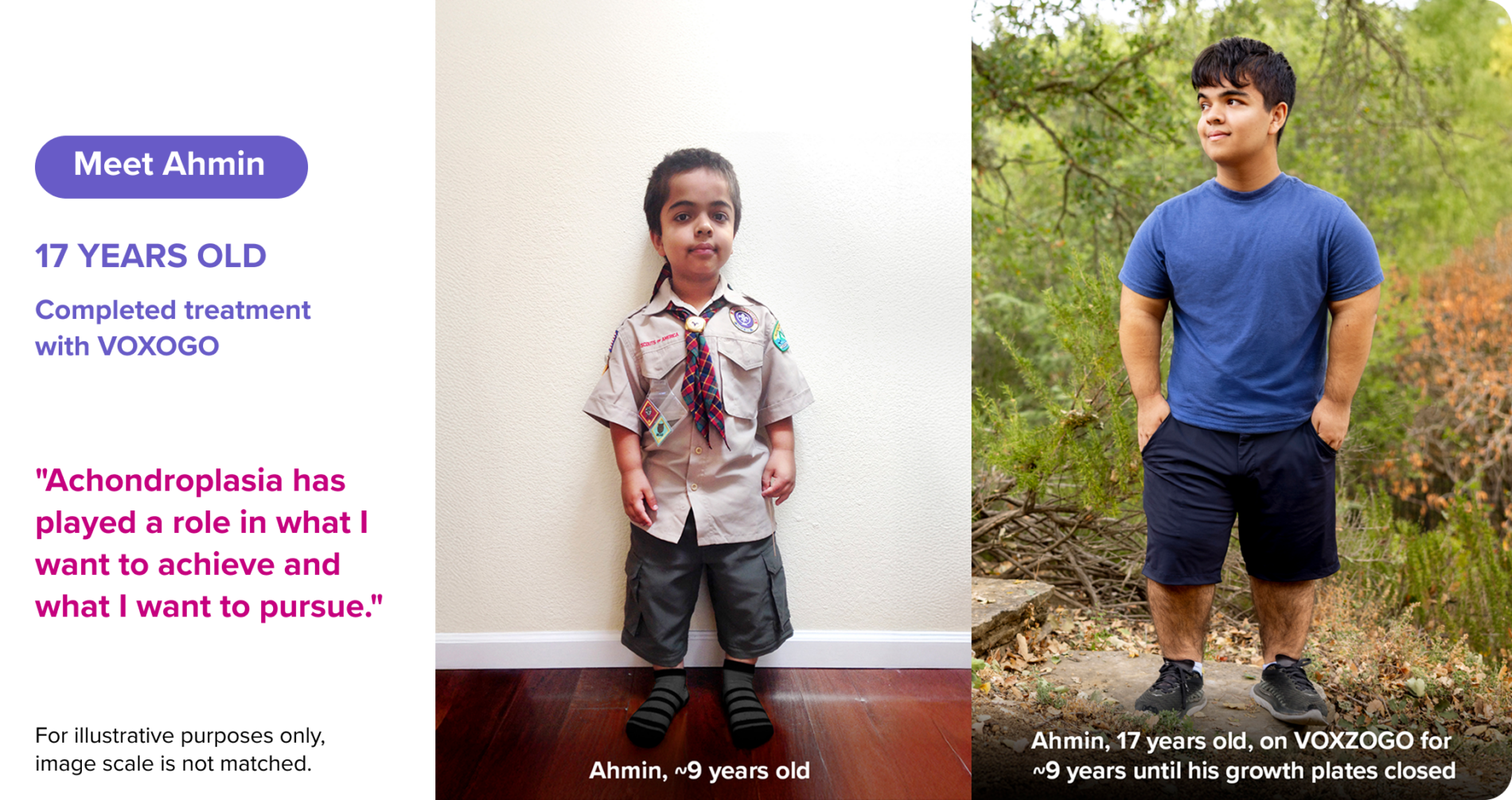 Ahmin at ages 9 and 17 after completing VOXZOGO treatment, illustrating growth until growth plate closure